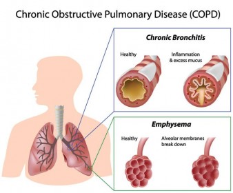 Tai Chi shown to improve COPD exercise capacity